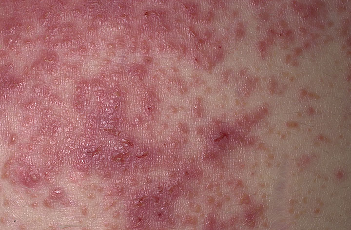 Ejemplo de piel afectada por dermatitis herpetiforme (DH)